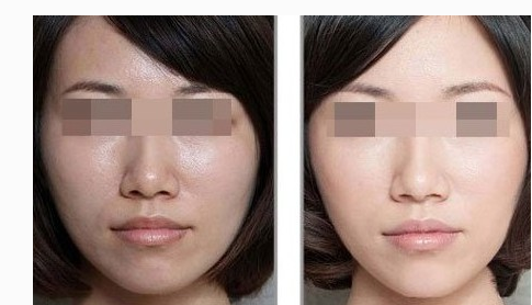 彩光嫩膚效果怎么樣呢