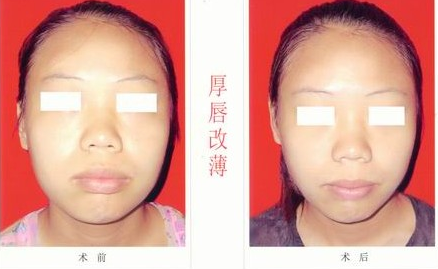 厚唇變薄手術(shù)價格多少錢