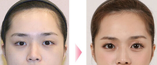 臥蠶整形手術(shù)的副作用有哪些呢