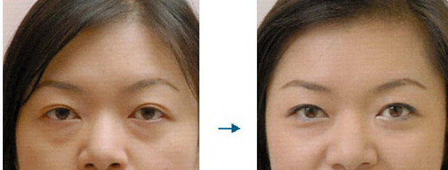 韓式提眉術(shù)術(shù)后需要多長(zhǎng)時(shí)間恢復(fù) - 珍美網(wǎng)