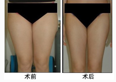 顧清大腿吸脂手術(shù)怎么樣 - 珍美網(wǎng)