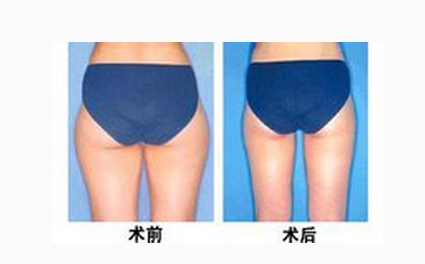 臀部吸脂術有什么副作用嗎