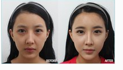 玻尿酸豐臥蠶效果好不好 - 珍美網(wǎng)