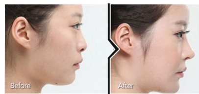 鼻尖整形手術(shù)效果怎么樣