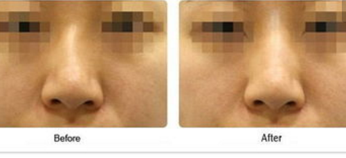 鼻骨整形手術(shù)效果好不好