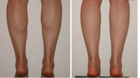 小腿吸脂手術(shù)多少錢