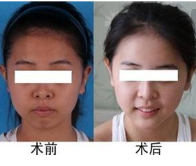 注射美白針的效果好不好