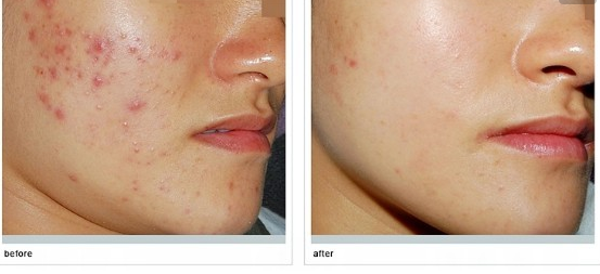 激光祛痘有沒有副作用呢