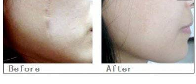 激光祛疤有副作用嗎 - 珍美網(wǎng)