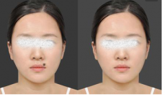 激光去痣有危害嗎