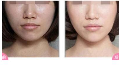 彩光嫩膚手術(shù)會有后遺癥嗎