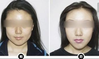 改臉型手術(shù)效果好不好