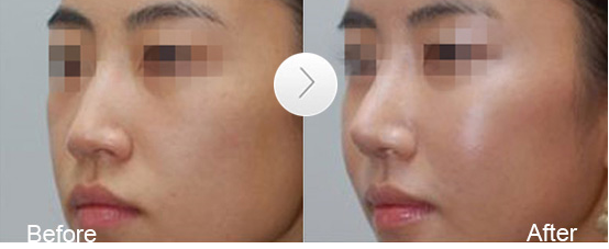 鼻尖整形手術(shù)有哪些副作用呢 - 珍美網(wǎng)