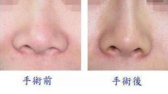 鼻翼縮小手術(shù)多少錢