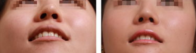 鼻部失敗修復(fù)手術(shù)效果好不好