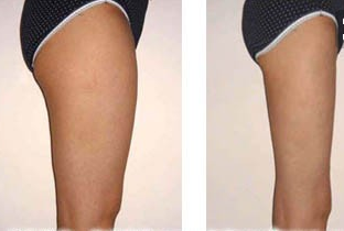 大腿吸脂手術(shù)多少錢