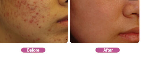 激光祛痘手術(shù)效果好不好