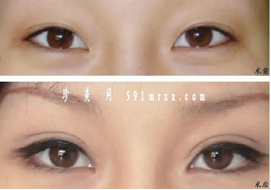 開眼角手術(shù)有危害嗎