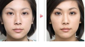 激光去眼袋手術效果好不好 - 珍美網(wǎng)