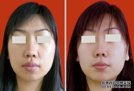 厚唇修薄術(shù)對(duì)比照