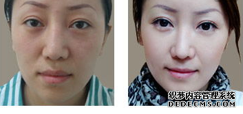 面部提升術(shù)對(duì)比照