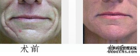 電波拉皮效果怎么樣