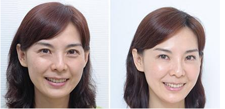 激光除皺手術(shù)對比照