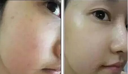 打水光針多久才有效果