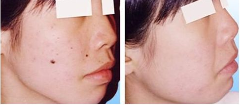 激光祛痣會不會留疤呢