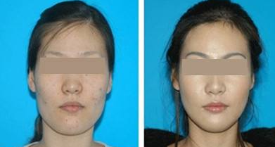 激光去除黑色素見效要多久