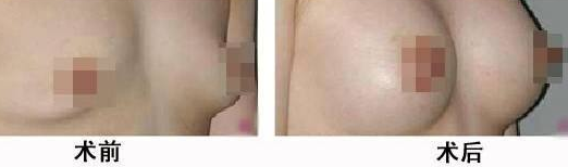 乳房再造手術(shù)有沒(méi)有危害呢