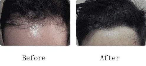 發(fā)際線種植有沒有危害呢