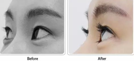 睫毛種植術(shù)效果好不好