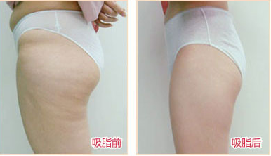 臀部吸脂手術(shù)對比照