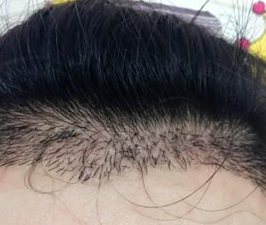 種植發(fā)際線  中分也可以很美麗