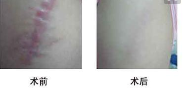 光子嫩膚去疤對(duì)比照