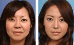 北京做面部提升術(shù)大概需要多少錢?