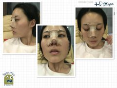 [案例]成都銅雀臺(tái)醫(yī)學(xué)美容醫(yī)院自體肋軟骨隆鼻日記