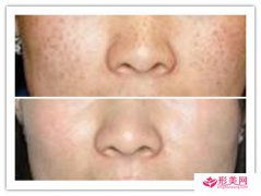 白瓷娃娃療程_白瓷娃娃一年做幾次比較好？