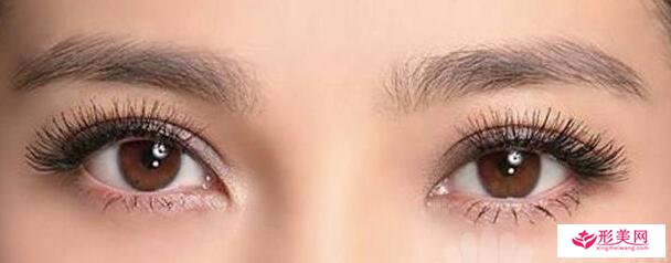 切開雙眼皮手術(shù)過程要多久