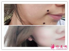 激光點痣有多疼-激光點痣疼嗎？