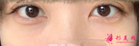 激光治療黑眼圈后要如何護理