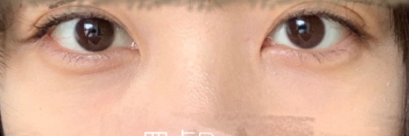 激光治療黑眼圈后要如何護(hù)理