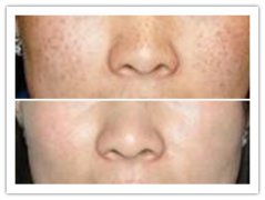 白瓷娃娃效果_做了白瓷娃娃之后會(huì)反彈嗎？