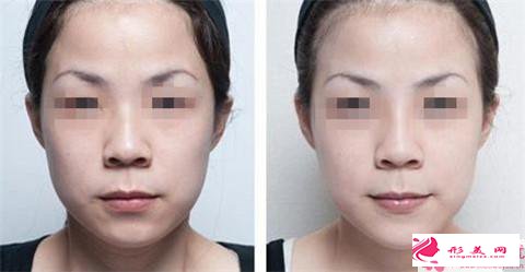 剛填充額頭需要注意些什么_額頭填充注意事項