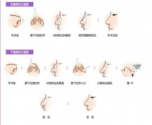 隆鼻后鼻子透光怎么辦？