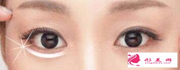 眼袋出現(xiàn)的原因有哪些?怎么祛眼袋