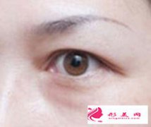 眼袋出現(xiàn)的原因有哪些?怎么祛眼袋?