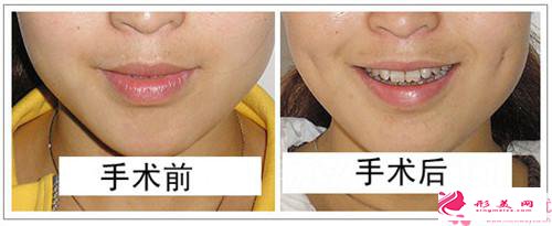 酒窩再造會出現(xiàn)的后果_酒窩再造可能會出現(xiàn)的問題有哪些