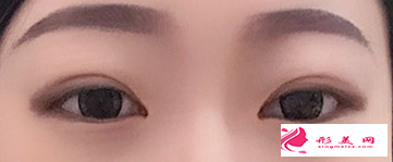 切開雙眼皮拆線后有疤痕怎么辦